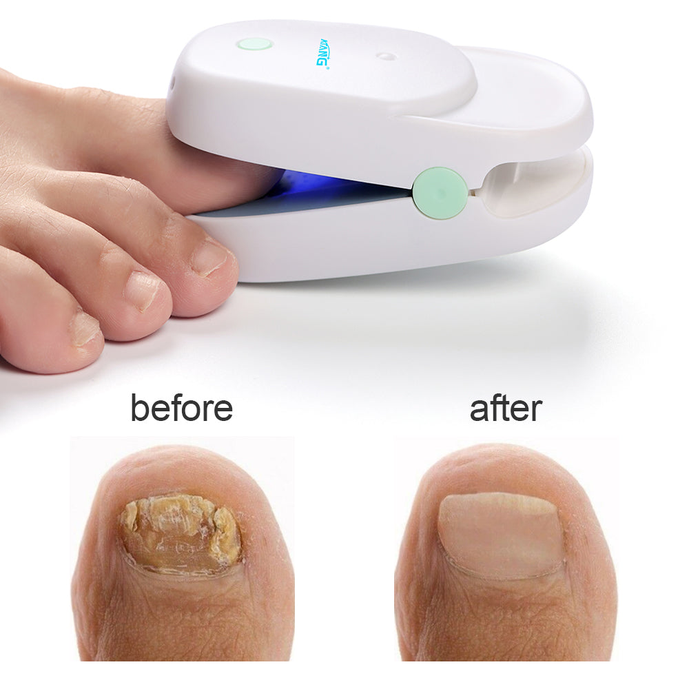 Atang New Fingernails Toenails Toe Nail Fungus Cold Laser Therapy