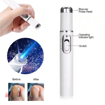 Hot Nail Fungal Treatment Pen Anti Fungus Blue Light Laser Pen