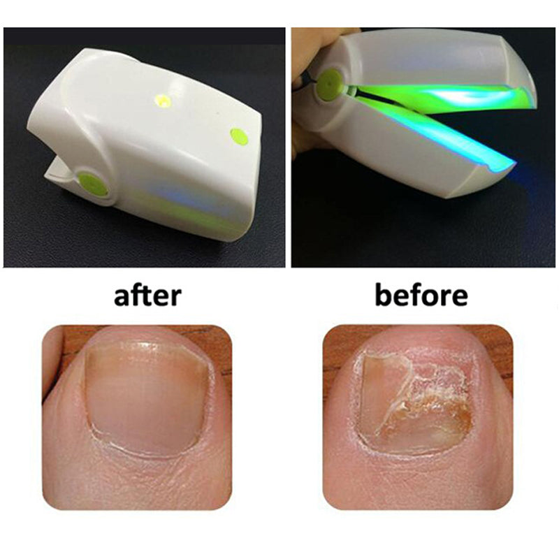 Portable nail laser fungus cold laser nail fungal Infection grey color